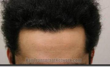 Hair restoration procedure results