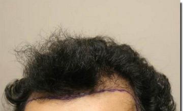 Hair restoration procedure results