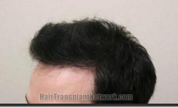 Hair restoration procedure results