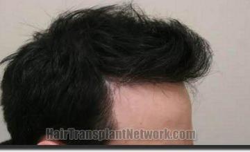 Hair restoration procedure results