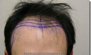 Hair restoration procedure results