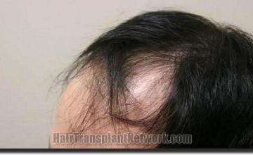 Hair restoration procedure results