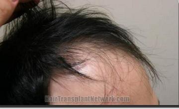 Hair restoration procedure results