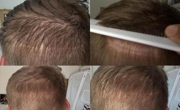 Surgical hair transplantation result photographs