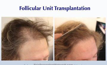 Female hair transplantation procedure before and after results