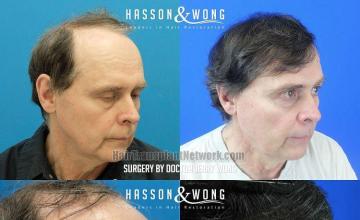 Hair transplantation procedure before and after results