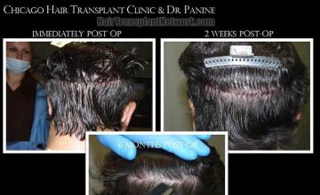 Hair restoration procedure before and after pictures