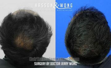 Surgical hair transplantation result photographs