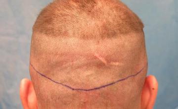 Hair transplantation procedure before and after photo results