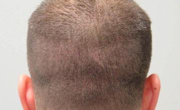 Hair transplant procedure before and after images