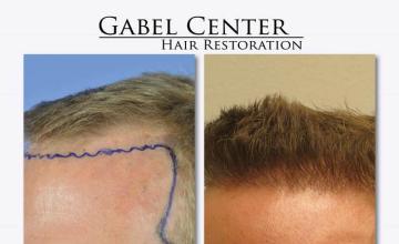 Hair restoration surgery before and after photos