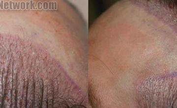 Hair transplantation surgery before and after pictures