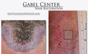 Hair restoration surgery before and after images