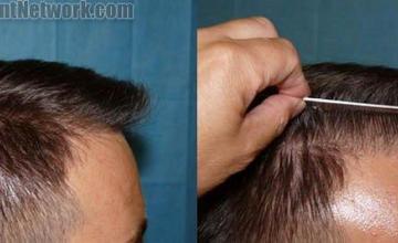 Right view before and after hair restoration procedure