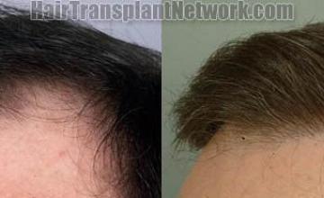 Right view before and after hair restoration procedure