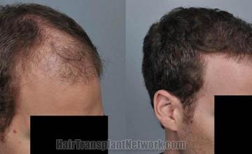 Hair transplantation surgery before and after photos