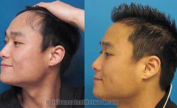 Hair transplantation surgery before and after photos