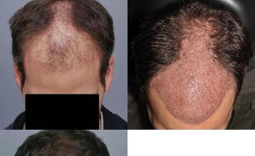 Top view before and after hair restoration results