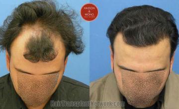 Top view - Before and after surgical hair replacement