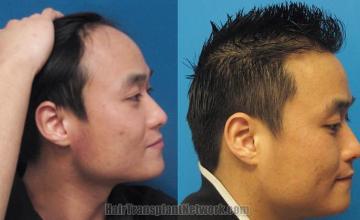 Hair restoration procedure before and after results