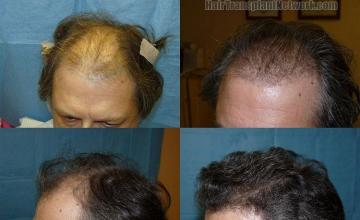 Hair restoration procedure results