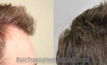 Hair transplantation surgery before and after images
