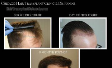 Hair restoration procedure before and after results