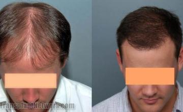 Hair restoration procedure results