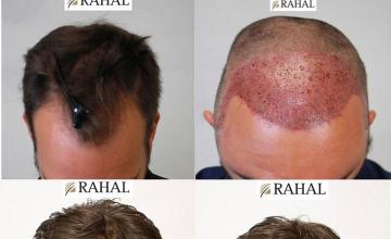 Before and after hair transplantation result photographs