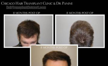 Hair restoration procedure before and after results