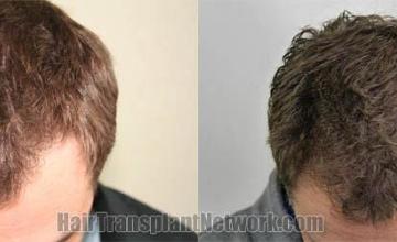 Hair transplantation surgery before and after photos
