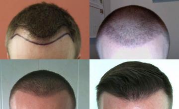 Hair transplantation surgery before and after photos