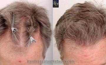 Hair restoration procedure before and after results