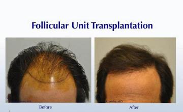 Hair transplantation surgery before and after photos