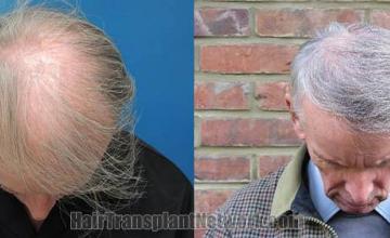 Top view - Before and after surgical hair replacement