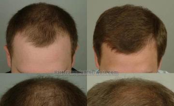 Top view before and after hair restoration results