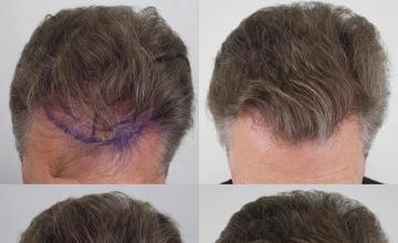 Hair transplantation surgery before and after photos