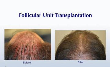 Hair restoration procedure before and after results