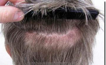 Hair restoration procedure results