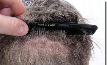Hair restoration procedure results