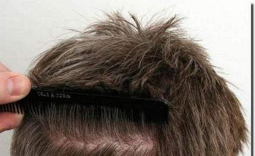 Hair restoration procedure results