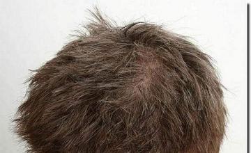 Hair restoration procedure results