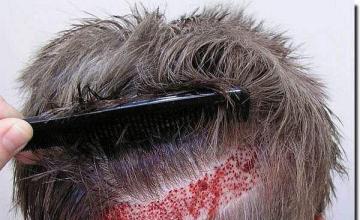 Hair restoration procedure results