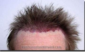 Hair restoration procedure results