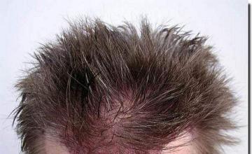 Hair restoration procedure results