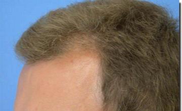 Hair restoration procedure results