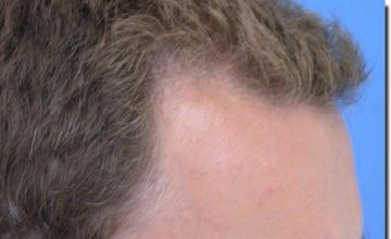 Hair restoration procedure results