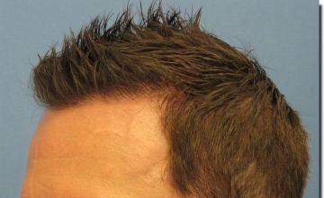 Hair restoration procedure results