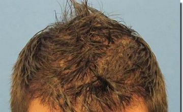 Hair restoration procedure results