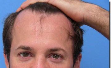 Hair restoration procedure results